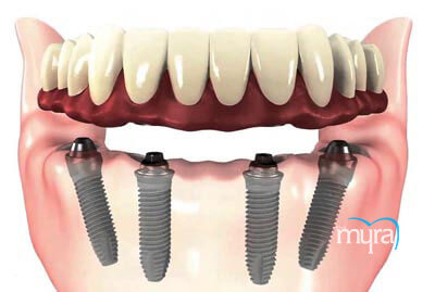All On 4 diş implantı, All On 4 diş implantı Nedir?