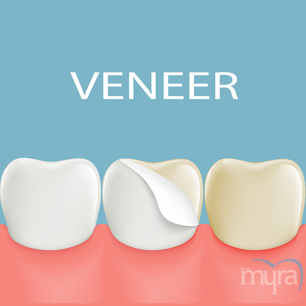 Laminate veneers nedir? Myra Dental · Ağız ve Diş Sağlığı Polikliniği