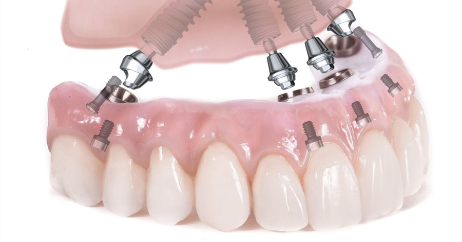 implant tedavisi, Antalya implant Diş Tedavisi