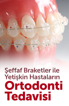 Ortodonti, Yetişkinlerde Ortodonti Tedavisi